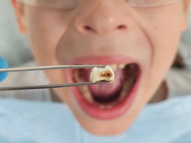 Best Emergency Dentist for Lost Fillings or Crowns in Mexico, MO