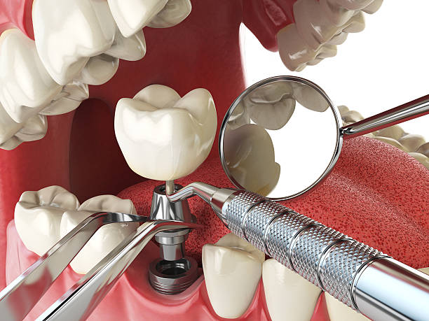 Best Broken or Cracked Tooth Emergency Dentist in Mexico, MO